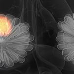 conceptual illustration of breast cancer