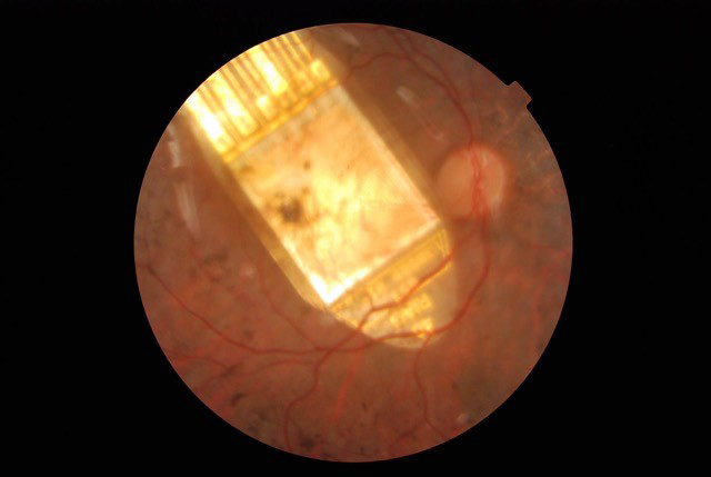 Retina showing electronic retinal implant