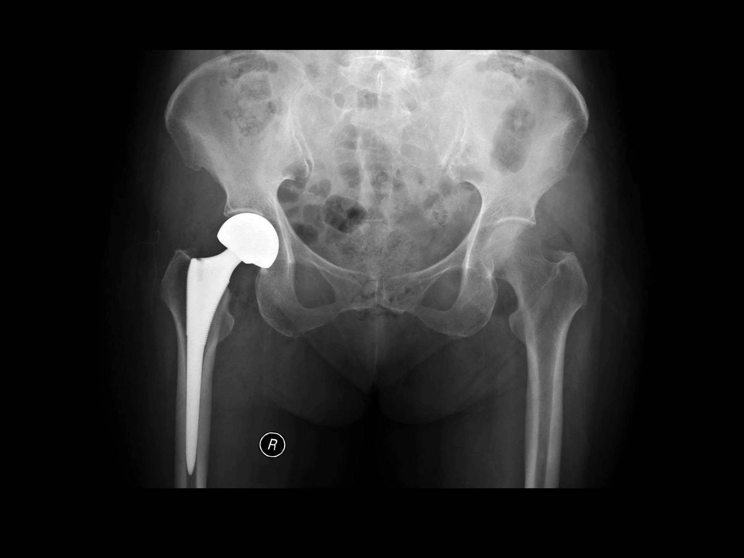 X-ray of a hip replacement