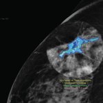 Mammogram image showing tumour highlighted  